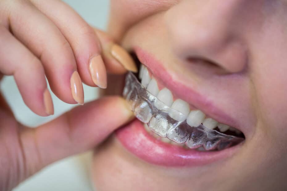 ortodontia estética, o que é, tratamentos, aparelhos e benefícios